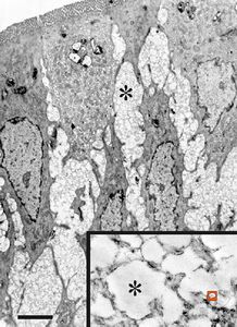 jejunum … lipid malabsorption